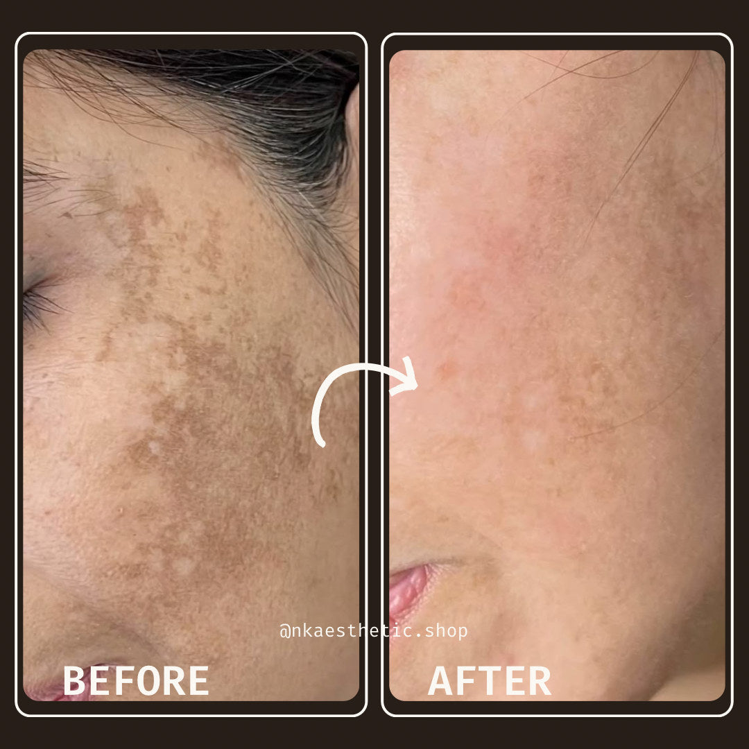 Customer photograph before and after using NK Aesthetics Bright and Shine