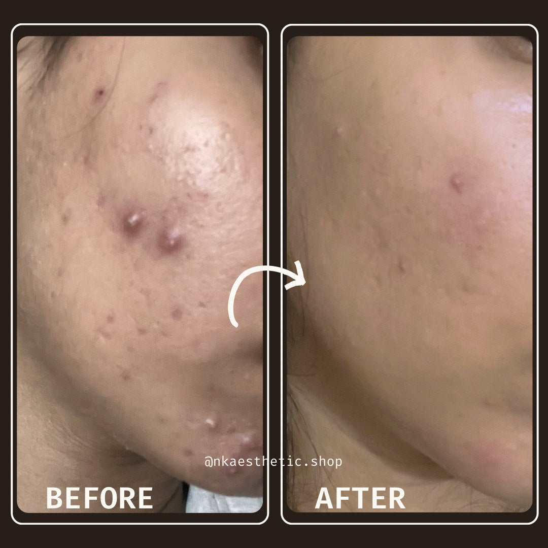 Customer photograph before and after using NK Aesthetics Derma-Ink