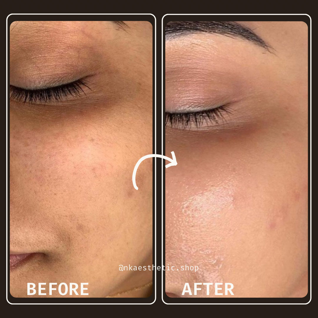 Customer photograph before and after using NK Aesthetics Jelly Belly
